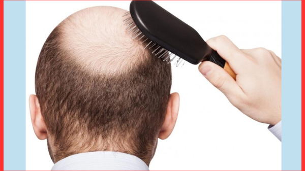 টাক পড়া কি হৃদরোগের আগাম সংকেত? যা বলছে বিজ্ঞান