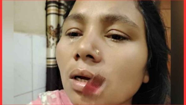 ননদের কামড়ে ভাবির ঠোঁট ক্ষতিগ্রস্ত, হাসপাতালে ভর্তি