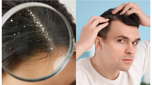 চিরতরে খুশকি দূর করার উপায়