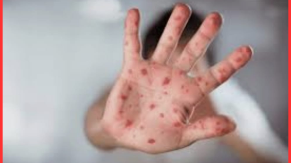 সারাদেশে হামে ১০০ শিশুর মৃত্যু: প্রধানমন্ত্রীর তড়িৎ পদক্ষেপ