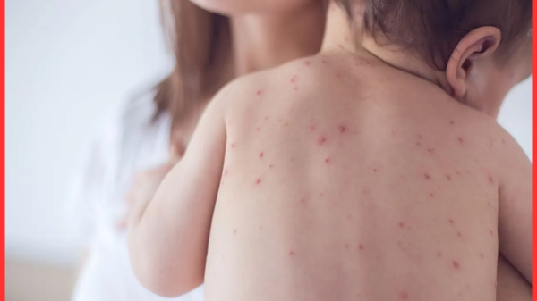 হাম কীভাবে ছড়ায়, জেনে নিন লক্ষণ ও প্রতিরোধ